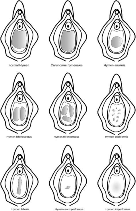 hymen foto|Hymen Types, Illustration